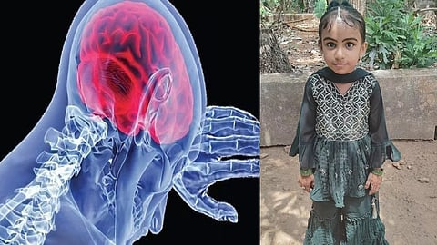 Amoebic encephalitis; Five year old died