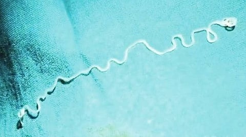 16 cm long worm was removed from the eye of a 20-year-old woman