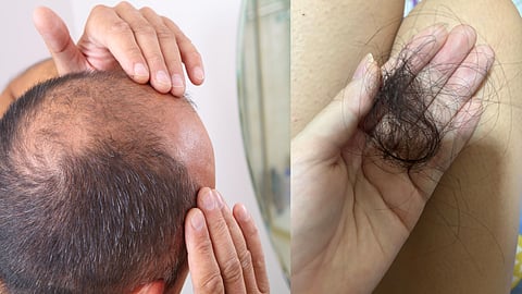 hairloss