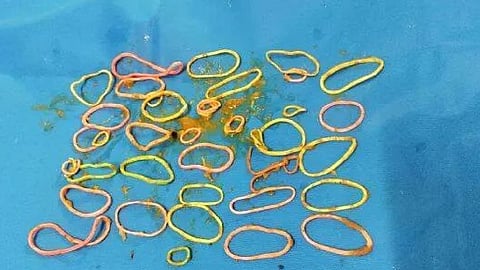 Rubber band chewing habit; 41 rubber bands removed from woman's stomach through surgery