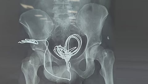 Electric wire removal surgery saved a young man