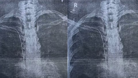 A woman has alleged Treatment negligence at Thiruvananthapuram General Hospital