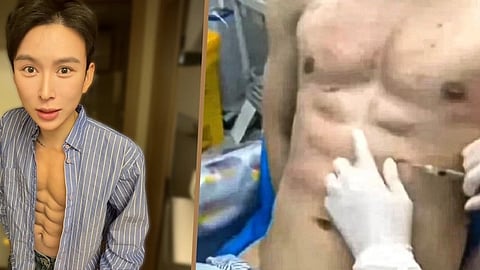 Chinese Man Spends Rs 5 Crore On Injections For 8-Pack Abs