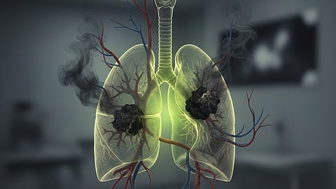 lung cancer