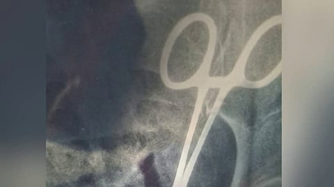 Scissors stuck in stomach at vandanam medical college incident