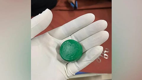 Bottle cap stuck in throat, removed; 10-month-old baby given new life