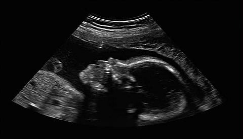 ഇരട്ടസഹോദരനെ ഗര്ഭം ധരിച്ച നവജാതശിശു; അപൂര്വമായി മാത്രം നടക്കുന്നതെന്ന് ഡോക്ടര്മാര്