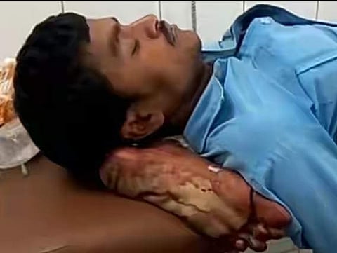 വാഹനാപകടത്തില് കാല് അറ്റുപോയ യുവാവിന് അതേ കാല് തന്നെ തലയണയാക്കി യോഗിയുടെ മെഡിക്കല് കോളേജ്