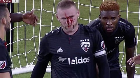 കളിക്കളം ചോരക്കളമാക്കി റൂണി, ആശങ്കയോടെ ആരാധകര്