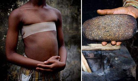 സ്തനവളര്ച്ച തടയാന് മാറിടത്തില് ചുട്ടകല്ല്: പ്രാകൃതരീതി പിന്തുടരുന്നത് ബ്രിട്ടനില് വര്ധിക്കുന്നു