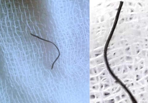 ഭക്ഷണത്തിനൊപ്പം അകത്തെത്തിയ ഇരുമ്പുകമ്പി അന്നനാളത്തിന് മുകളില് കുടുങ്ങി ; സങ്കീര്ണ ശസ്ത്രക്രിയയിലൂടെ യുവാവിന് പുതുജീവിതം