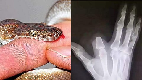 പാമ്പ് വിരലില് കടിച്ചു, അഞ്ചടി നടന്നാല് മരണം സംഭവിക്കുമെന്ന് ഭയം; വിരല് മുറിച്ചെറിഞ്ഞ് ഓടി ആശുപത്രിയിലേക്ക്