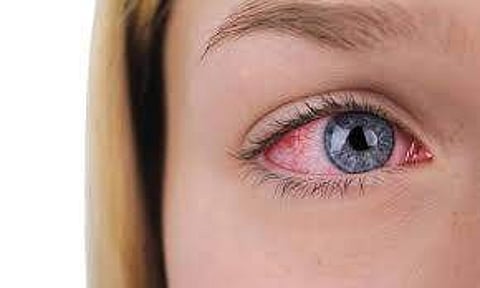 മൈഗ്രേനും കണ്ണ് വരള്ച്ചയും തമ്മില് ചെറിയ ബന്ധമൊന്നുമല്ല..!