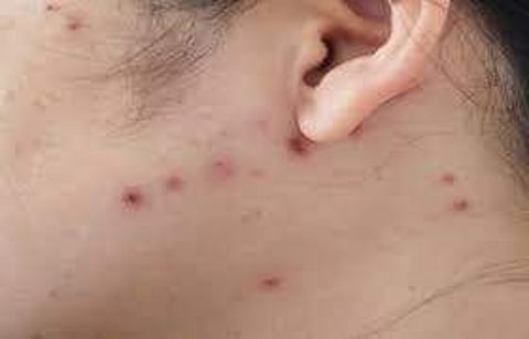 ചിക്കന്പോക്സ് പടര്ന്നു പിടിക്കുന്നു; ശ്രദ്ധിക്കണമെന്ന് ആരോഗ്യവകുപ്പ്