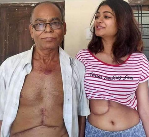 കരളിന്റെ പാതിയിലധികവും അച്ഛന് നല്കിയ 19കാരി: പ്രശംസിച്ച് സോഷ്യല്മീഡിയ