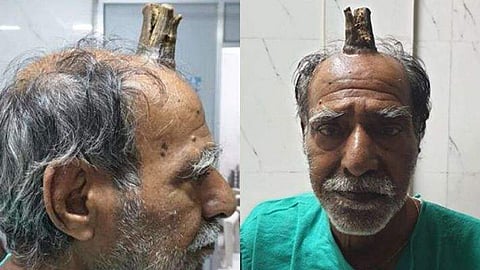 തലയില് 'ചെകുത്താന് കൊമ്പു'മായി 72കാരന്; സങ്കീര്ണ്ണമായ ശസ്ത്രക്രിയ, രക്ഷപ്പെടല്