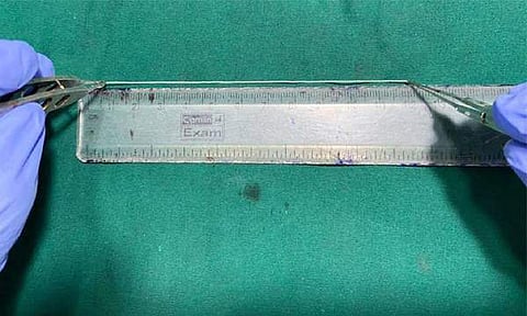 വീട്ടമ്മയുടെ കണ്ണില് 12.5 സെന്റിമീറ്റര് നീളമുളള വിര; ശസ്ത്രക്രിയയിലൂടെ പുറത്തെടുത്തു