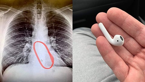 എയര്പോഡ് വിഴുങ്ങിയതിന്റെ എക്സറേ