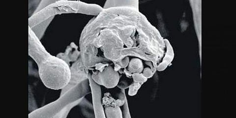 ബ്ലാക്ക് ഫംഗസ് സ്കാൻ ചിത്രം