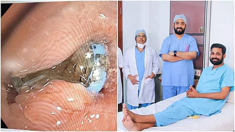 ശ്വാസകോശത്തില് കുരുങ്ങിയ പേനയുടെ നിബ്, സൂരജിനൊപ്പം അമൃത ആശുപത്രിയിലെ ഡോക്ടര്മാര്/ എക്സ്പ്രസ്