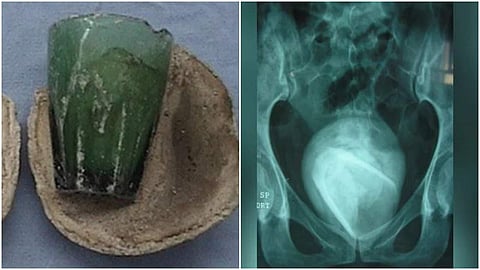 മൂത്രാശയത്തില് നിന്ന് നീക്കം ചെയ്ത ഗ്ലാസ് ടംബ്ലര്