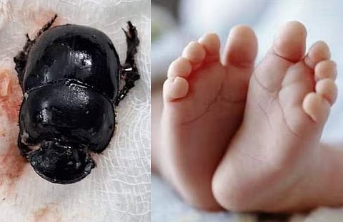 കുട്ടിയുടെ തൊണ്ടയിൽ നിന്ന് പുറത്തെടുത്ത വണ്ട്