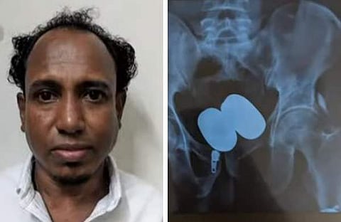 സതീഷ്- ശരീരത്തിനുള്ളില് ക്യാപ്സൂള് രൂപത്തില് ഒളിപ്പിച്ച സ്വര്ണം