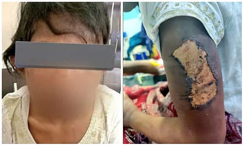 ദമ്പതികളുടെ മര്ദനത്തില് ക്രൂരമായി പരിക്കേറ്റ 13കാരി