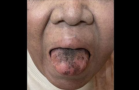 ആന്റിബയോട്ടിക്കിനോട് അലർജി/ കേസ്റിപ്പോർട്ട്സ് പ്രസിദ്ധീകരിച്ച ചിത്രം