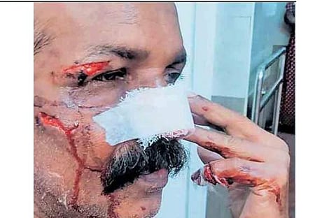 കുറുക്കന്റെ ആക്രമണത്തില് മുഖത്ത് പരിക്കേറ്റ ബേബി