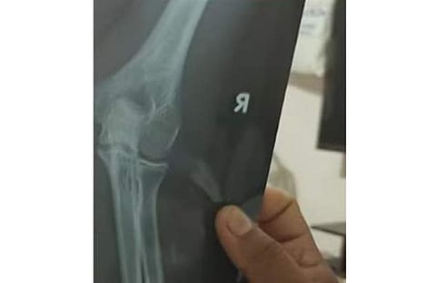 സ്കൂൾ വിദ്യാർഥിയുടെ കൈ ഒടിഞ്ഞതിന്റെ എക്സറേ ദൃശ്യം