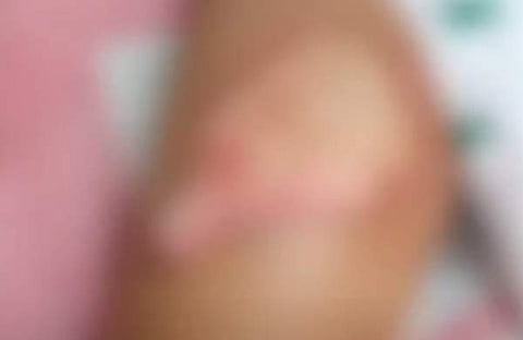 പൊള്ളലേറ്റ കുട്ടി ചികിത്സയിൽ, സ്ക്രീൻഷോട്ട്