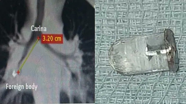 അഞ്ചുവയസുകാരന്റെ ശ്വാസകോശത്തില്‍ എല്‍ഇഡി ബള്‍ബ്; ശസ്ത്രക്രിയയിലുടെ പുറത്തെടുത്തു