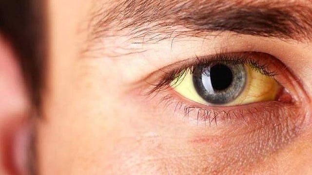 JAUNDICE