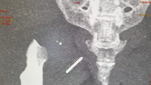 ഇടുപ്പിൽ സൂചി തറഞ്ഞിരുന്നത് മൂന്നു വർഷം; അപൂർവ ശസ്ത്രക്രിയയിലൂടെ പുറത്തെടുത്തു