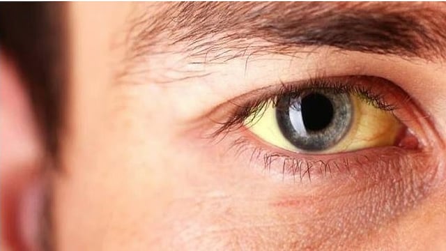 Jaundice