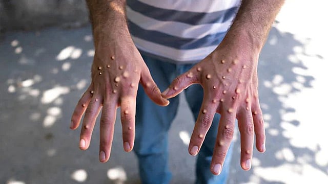 mpox