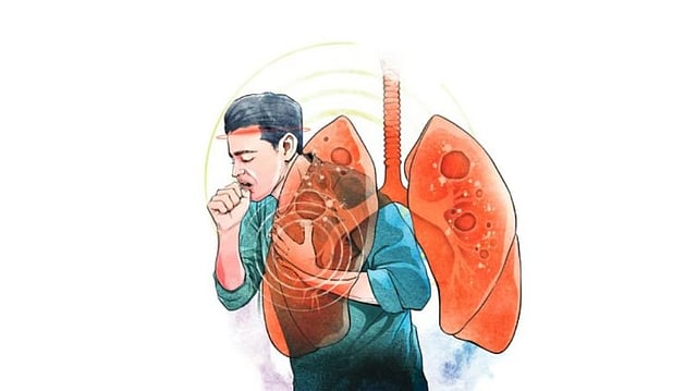 tuberculosis