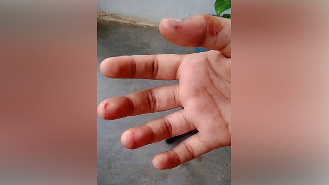 14-year-old girl bitten by fox