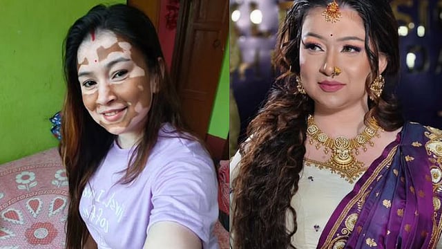 മുറിവ് ഉണങ്ങിയപ്പോഴാണ് വെള്ളപ്പാണ്ട് തിരിച്ചറിയുന്നത്, ബസില് ഇരിക്കാന് പോലും അനുവദിച്ചിരുന്നില്ല