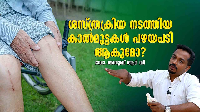ചമ്രം പടിഞ്ഞിരുന്ന് സദ്യ കഴിക്കാന് പറ്റില്ല!; മുട്ടു മാറ്റിവയ്ക്കല് ശസ്ത്രക്രിയ, അറിഞ്ഞിരിക്കണം ഇക്കാര്യങ്ങള്