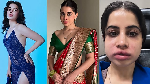 'ഫില്ലറുകള് പണി തന്നു, മുഖവും ചുണ്ടും നീരുവച്ച് വീര്ത്തു'; തലവേദന അസഹനീയമെന്ന് ഉര്ഫി, വീഡിയോ