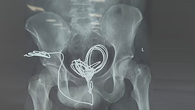 Electric wire removal surgery saved a young man