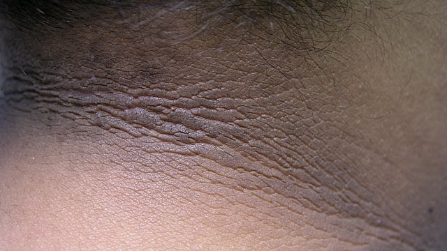 Acanthosis Nigricans