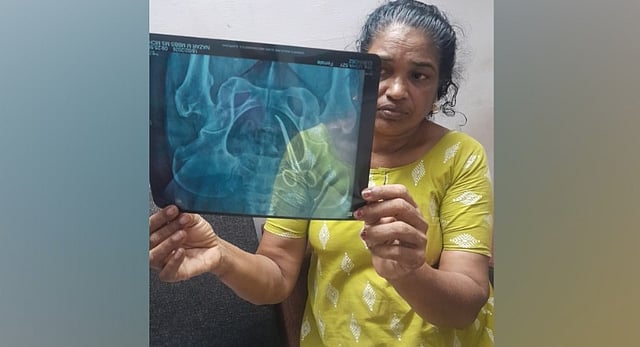ശസ്ത്രക്രിയ അഞ്ചുവര്ഷം മുന്പ്; വയറുവേദനയ്ക്ക് മാറ്റമില്ല; കണ്ടെത്തിയത് 'കത്രിക'