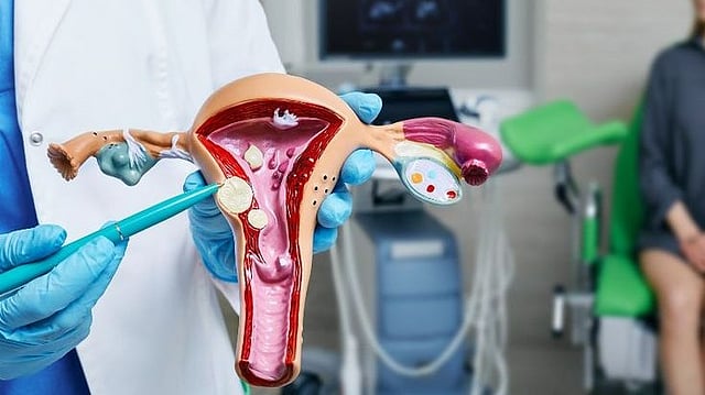 Uterine Fibroids