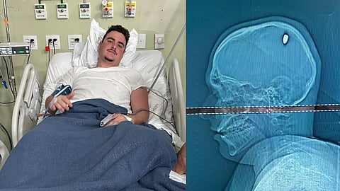 മത്തേസ് ഫാസിയോ ആശുപത്രിയില്‍, തലയില്‍ ബുള്ളറ്റ് തുളച്ചു കയറിയതിന്‍റെ എക്സ്റേ