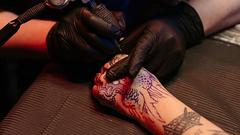 ടാറ്റൂ നീക്കം ചെയ്യാന്‍ ലേസര്‍ ചികിത്സ