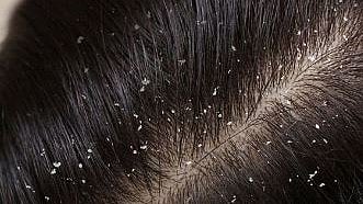 സ്കാൽപ് സോറിയാസിസ്