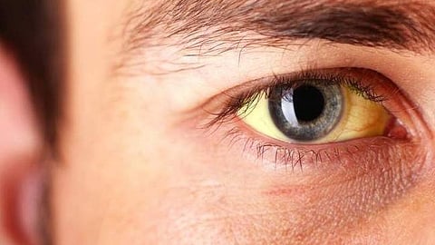 condition of two people suffering from hepatitis in Vengur 